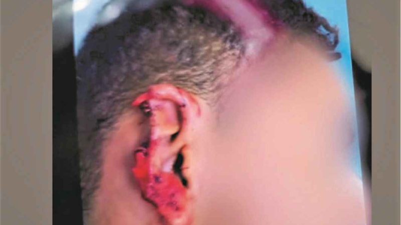 Polícia Municipal detém acusado de arrancar parte de orelha de Homem